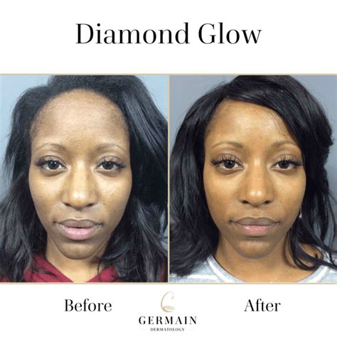 Diamond Glow Before And After Mt Pleasant Summerville Sc