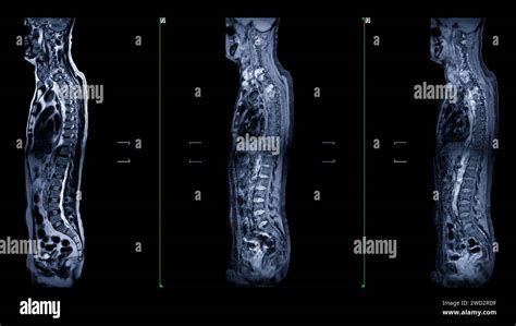 An Mri Of The Whole Spine Image Is A Comprehensive Visual