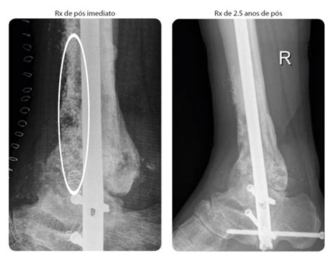 Osteomielite Tratamento De Infecções ósseas Dra Ana Paula Simões