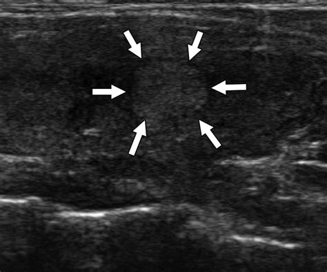 Assessment Of The American College Of Radiology Thyroid Imaging