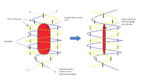 Shoelace technique for Delayed Primary Closure | Epomedicine