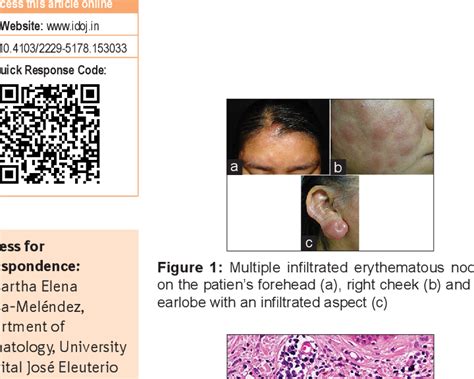 Figure 1 From Skindia Quiz 18 Multiple Erythematous Nodules In A 30