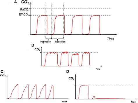 Frontiers Capnography Waveforms Basic Interpretation In Neonatal