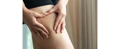 Nggak Perlu Ribet Ini Trik Hilangkan Stretch Marks Di Badan Cuma Pakai