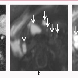 Branch Duct Intraductal Papillary Mucinous Neoplasm BD IPMN