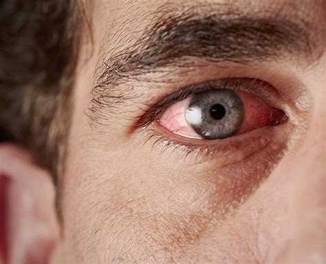 Red Eyes Causes Symptoms And Treatment Goyal Eye