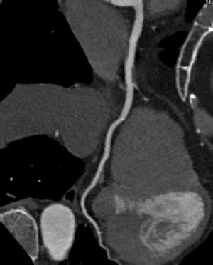 Angiotomografia das Artérias Coronárias Clínica Radcenter Clínica