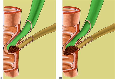 Ampulla of Vater: Comprehensive anatomy, MR imaging of pathologic conditions, and correlation ...