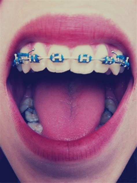 Brackets De Colores Imagui