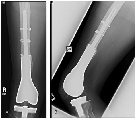 Trabecular Metal Endoprosthetic Limb Salvage Reconstruction Of The