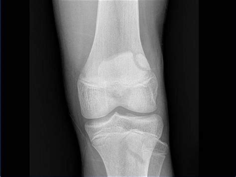 Bipartite Patella Types