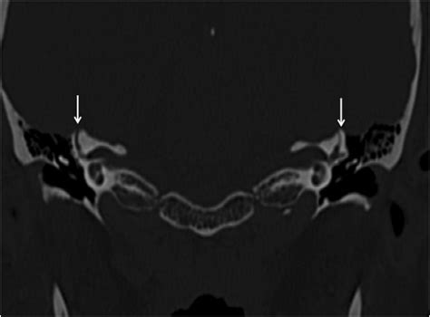 Superior Semicircular Canal Dehiscence | Canadian Audiologist