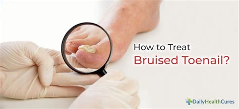 Bruised Toenail: Causes, Types, Home Remedies, and Healing Time