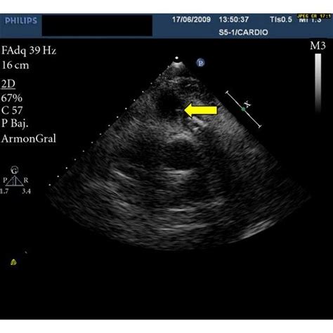 Transesophageal Echocardiography Showing Interatrial Communication With