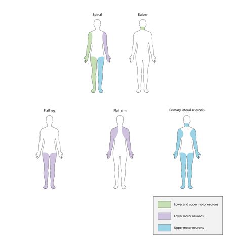 Als Upper And Lower Motor Neuron Signs Infoupdate Org