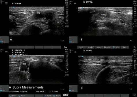 Frontiers Case Study Treating Infraspinatus And Supraspinatus