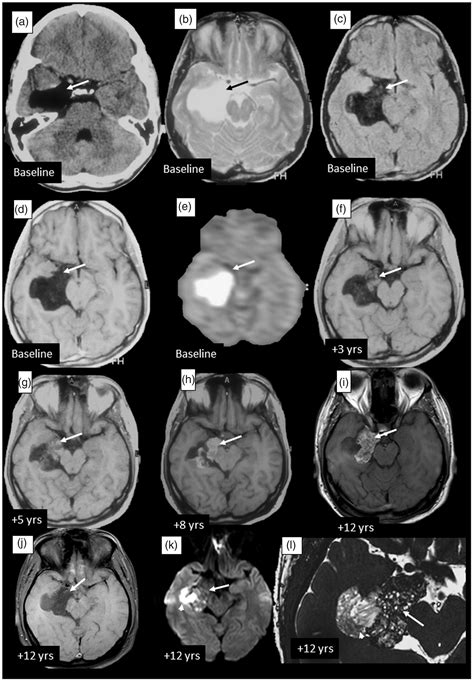 Dermoid Tumor Brain Mri