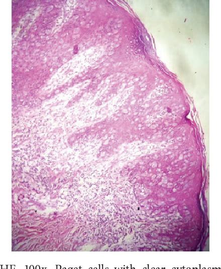 Figure 1 From Paget Disease Of The Vulva Diagnosis By Immunohistochemistry Semantic Scholar