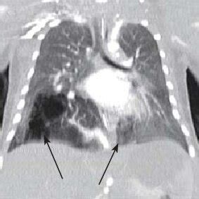 Thorax CT demonstrates bilateral pulmonary sequestration in the right ...