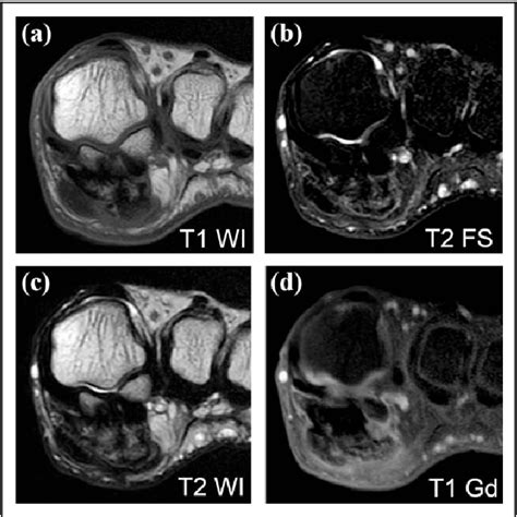 Figure From A Bizarre Parosteal Osteochondromatous Proliferation At