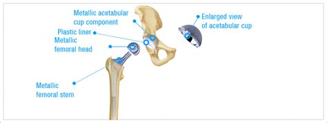 Hip Replacement Surgery Procedures Miot Hospitals