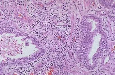 慢性细菌性前列腺炎【多图】39医疗图集 39健康网