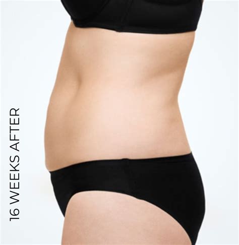 Coolsculpting Fat Freezing Before And After Images London