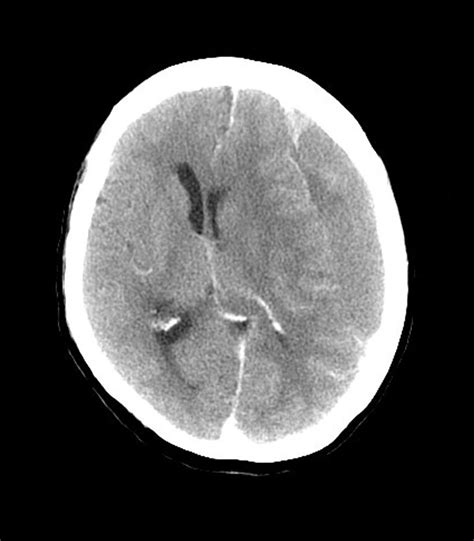 Subdural Haemorrhage Mri Scan By Du Cane Medical Imaging Ltd