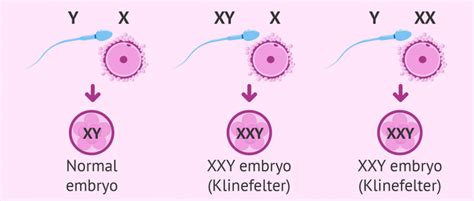 Genetic causes of Klinefelter syndrome