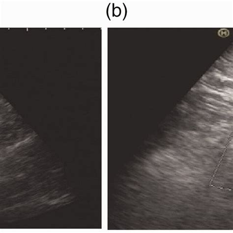 Representative Doppler Ultrasonography Images Showing The Puncture