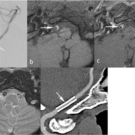 Soft Lesion In A Patient With Dissection A Year Old Man Suffered