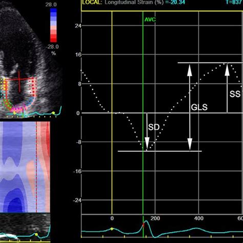 A Normal Left Atrial Strain Curve In A Complete Cardiac Cycle La