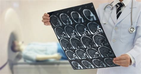 Bulbar-Onset ALS Patients Found to Have Extensive Brain Tissue Loss