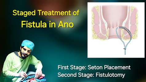 Seton Treatment Of Fistula In Ano Dr Tayyab Riaz Ch YouTube