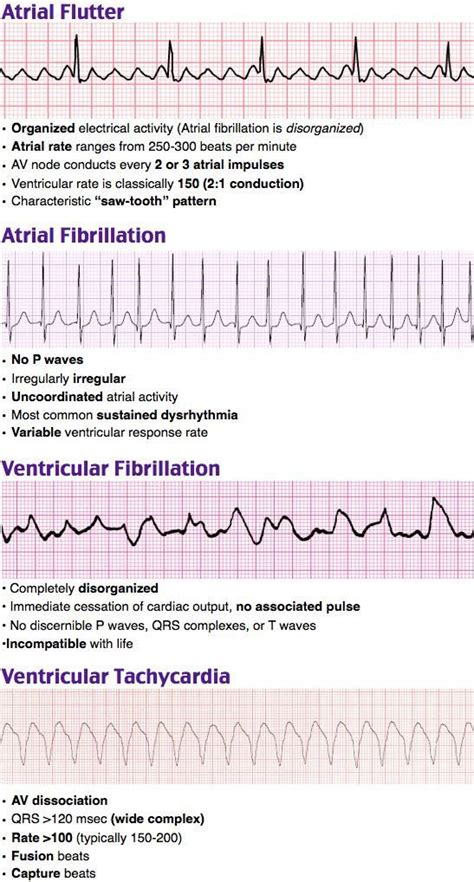 Atrial Flutter Vs Atrial Fibrillation Ecg