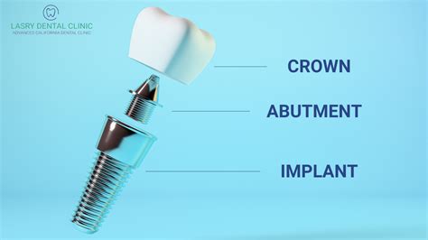 Dental Implant Cost Your Complete Guide To A Brand New Smile