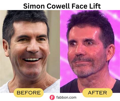 Revealed : 8 Cosmetic Procedures Simon Cowell Has Undergone As Per ...