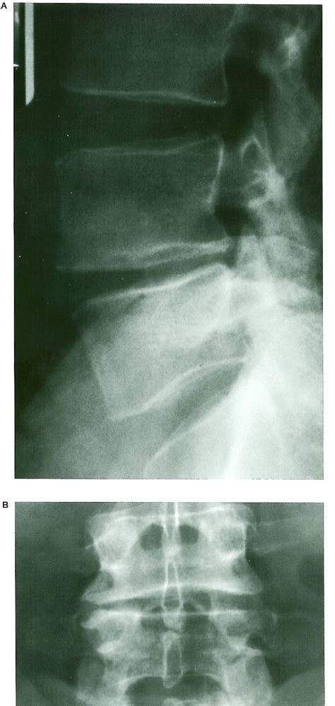 Figure 4 From Single Segment Lumbar Interbody Arthrodesis With