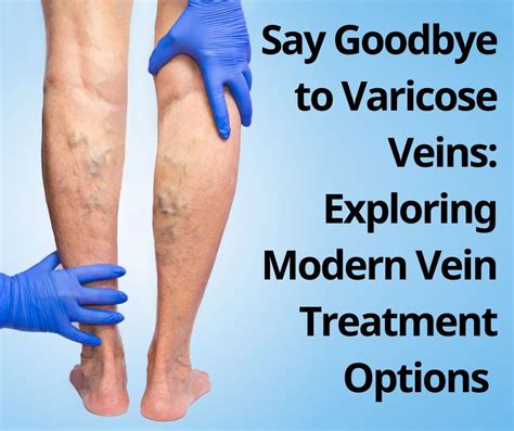 Say Goodbye To Varicose Veins Exploring Modern Vein Treatment Options