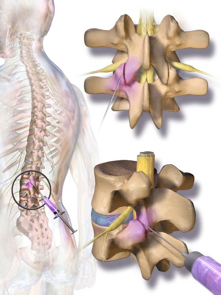 Lumbar Spondylosis Physiopedia