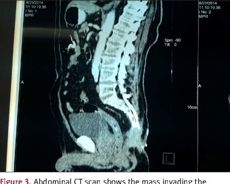 Pilonidal Cyst Mri