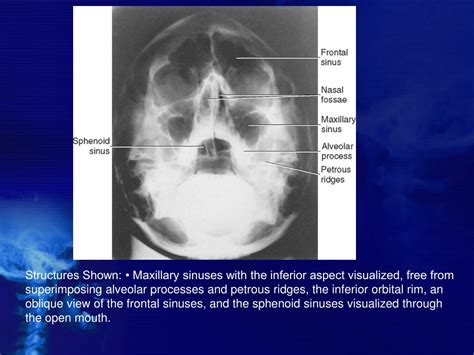 Ppt Paranasal Sinuses Anatomy Pathology Powerpoint Presentation