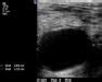 Popliteal artery aneurysm