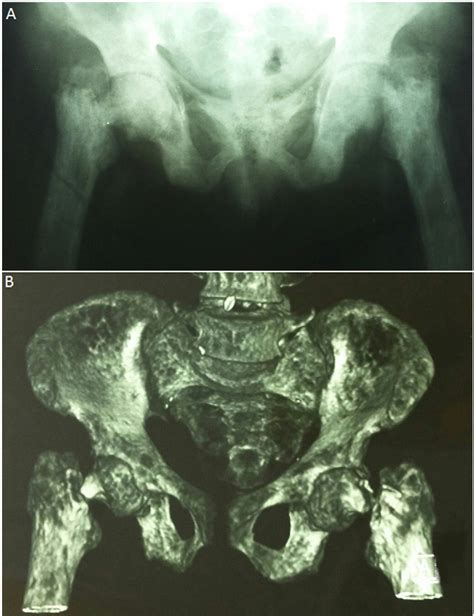 Figure From Simultaneous Bilateral Femoral Neck Fracture In A Patient