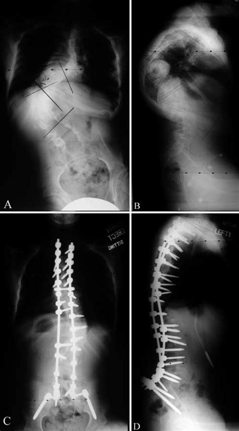 Preoperative Posteroanterior A And Lateral B Full Spine Radiographs Download Scientific