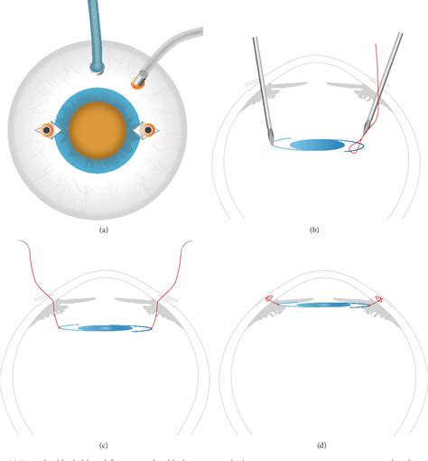 Suturing Technique For Scleral Fixation Of Toric 49 OFF