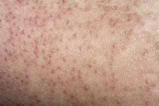 Keratosis pilaris - NHS