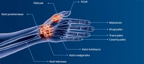 Kontuzje I Stabilizacja Nadgarstka Emedicalbroker