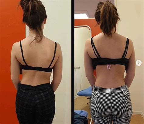 Severe Scoliosis Before And After