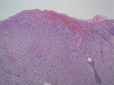 Dermal Highly Vascularized Ulcerated Tumor Composed Of Atypical